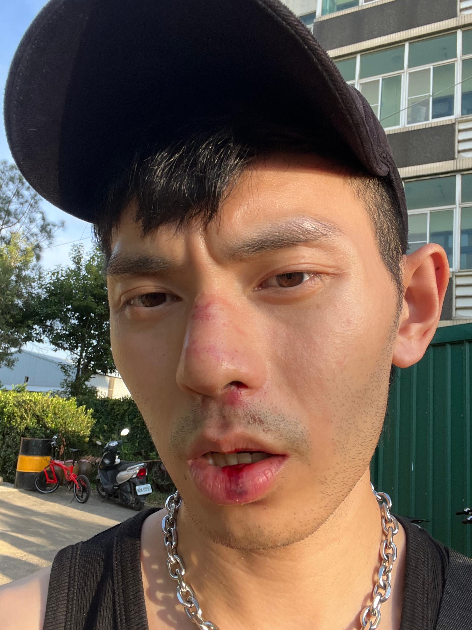 Fuying & Sam时隔2年合体回归 Fuying摔倒溅血缝3针 - PopTrendMedia